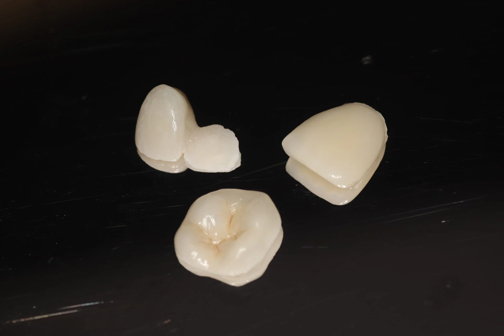 Facings en kronen